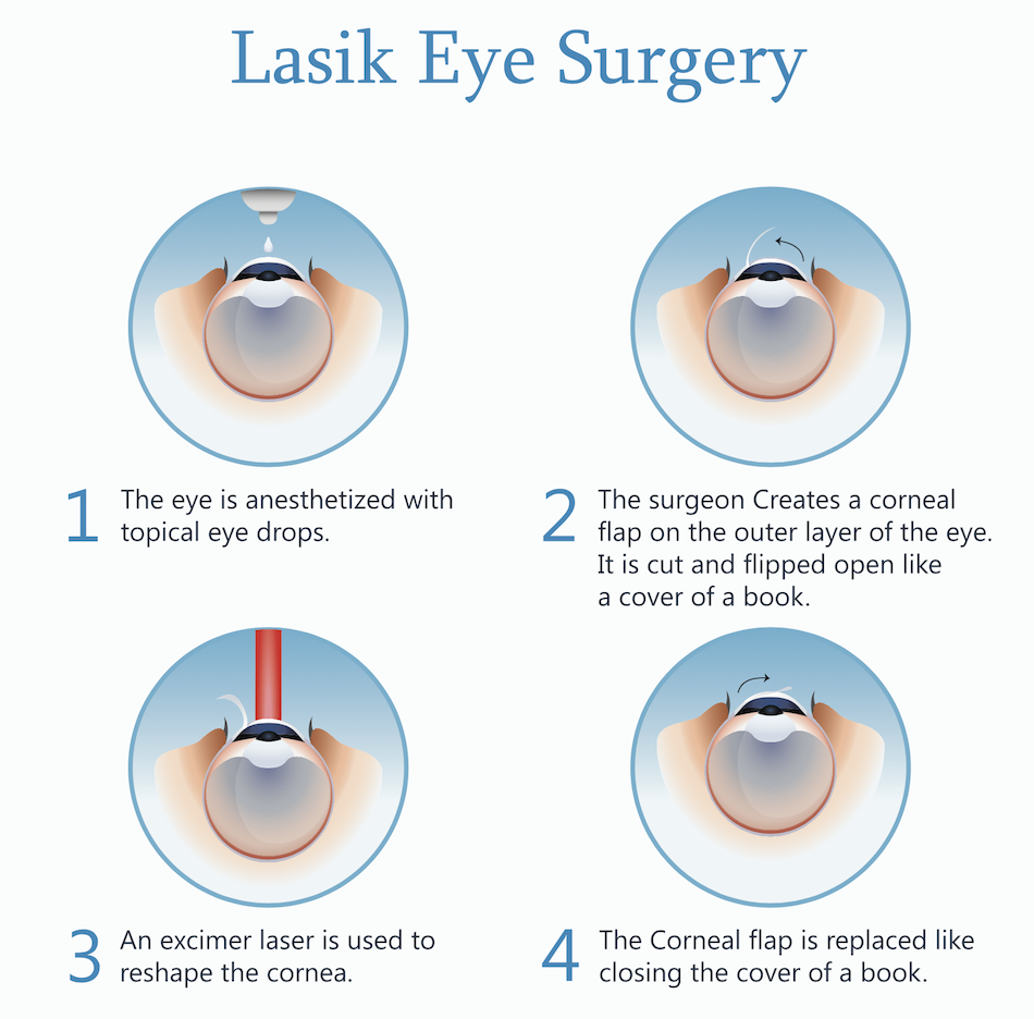 Astigmatism laser eye surgery | doctorvisit