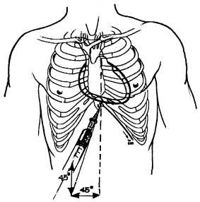 Pericadio Centesis