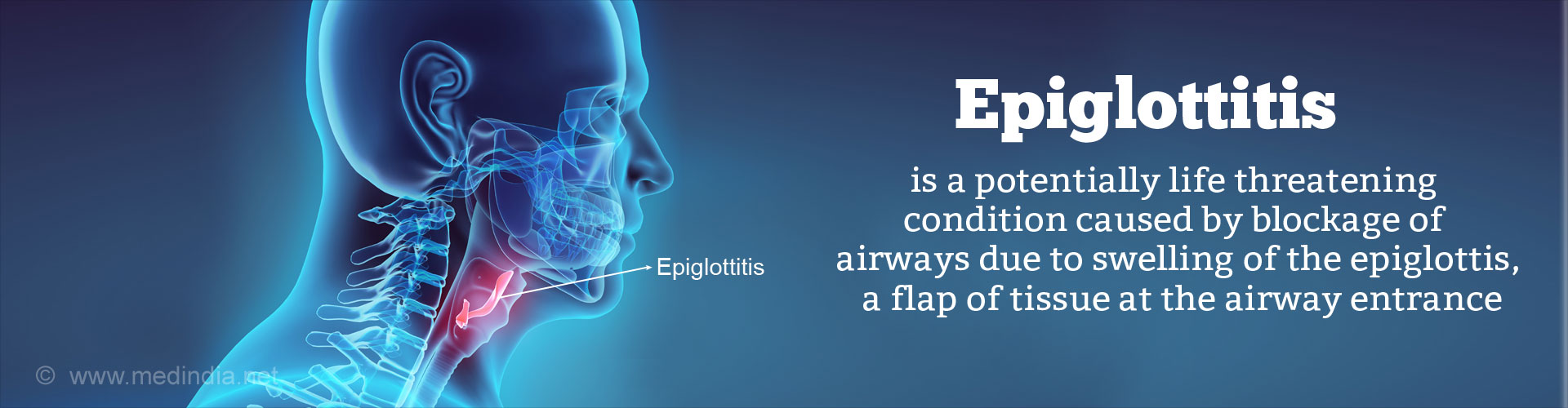 Epiglottitis - Causes, Signs and Symptoms, Diagnosis, Treatment ...