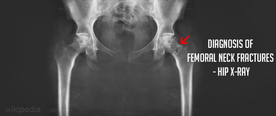 Femur Fracture X Ray