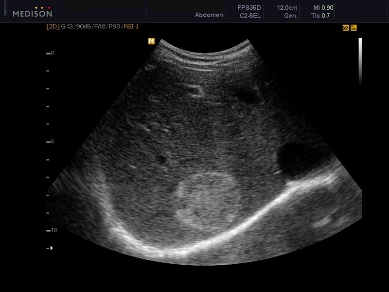 Hepatic Hemangioma Ultrasound