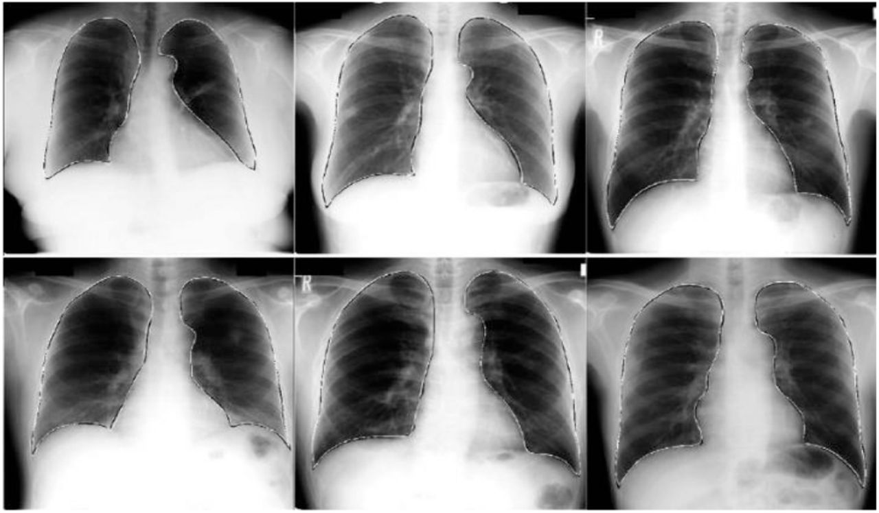 Viral pneumonia chest x ray findings - looksrat