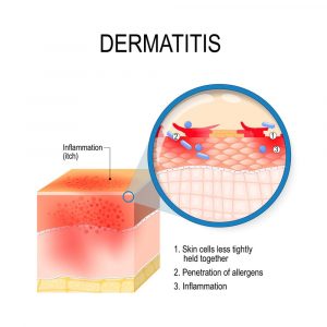 Dermatitis