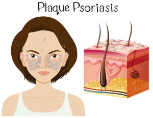 Plaque Psoriasis