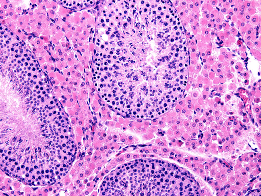 Mesothelioma Types : mesothelioma epithelioid type #Mesothelioma ...