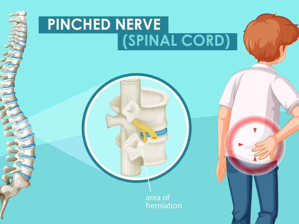 How To Fix A Pinched Nerve In The Neck Causes Symptom - vrogue.co