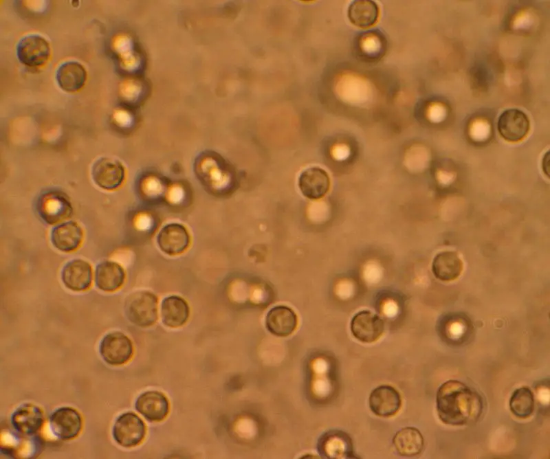 Multiple white cells seen in the urine of a person with a urinary tract infection using a microscopy