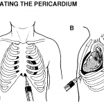 xiphoid process lump symptoms - ModernHeal.com