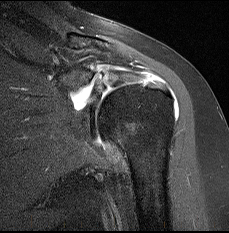 Shoulder Impingement MRI