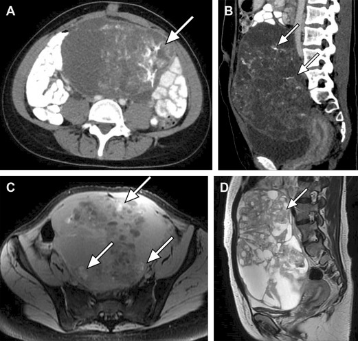 MR Imaging–Pathologic Correlation in Ovarian Cancer - Magnetic ...