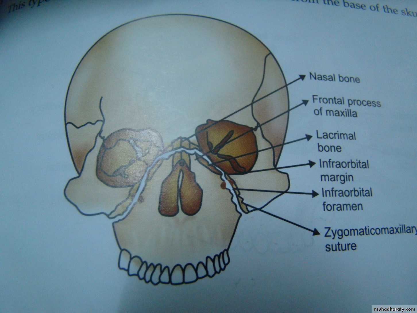 Maxillary Fracture