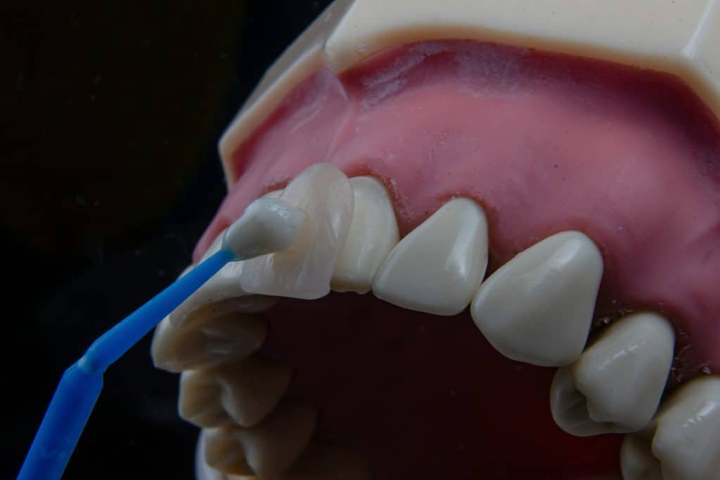 Composite Veneers