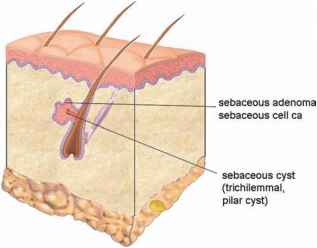 Eyelid Lesions and Tissues of Origin - Cell Carcinoma