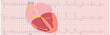 Right Bundle Branch Block