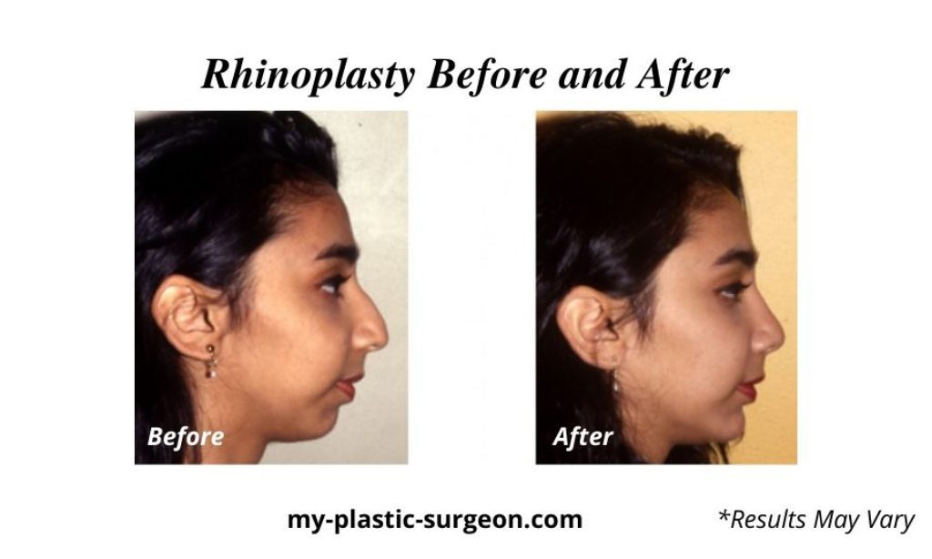 Too Young for a Rhinoplasty? | J. Brian Boyd, .