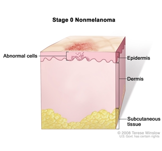 Skin Cancer Treatment (PDQ®): Treatment - Patient Information [NCI]