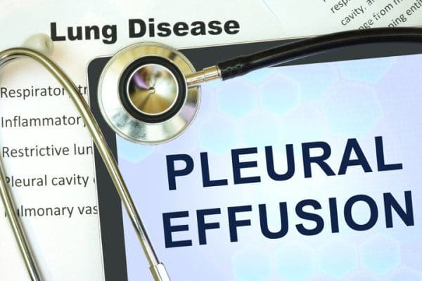 Pleural effusion and early identification