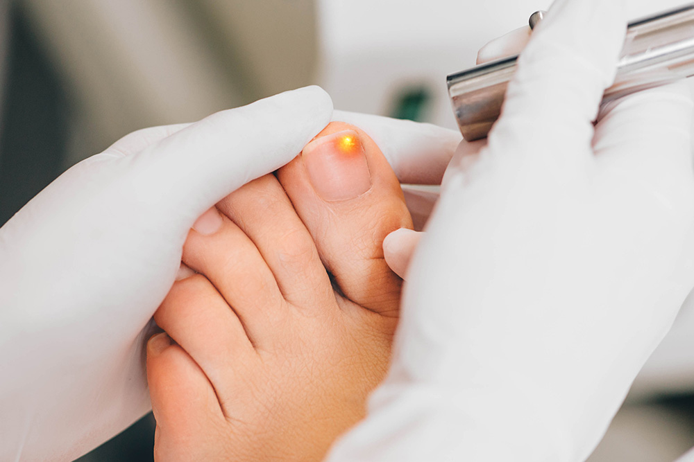 Fungal Nail Laser Treatment