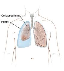 Risk factors for atelactasis - NAMAT blog