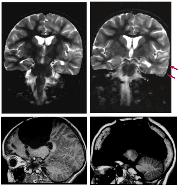 Severe Neocortical Epileptic Syndromes in Infancy and Childhood - The ...