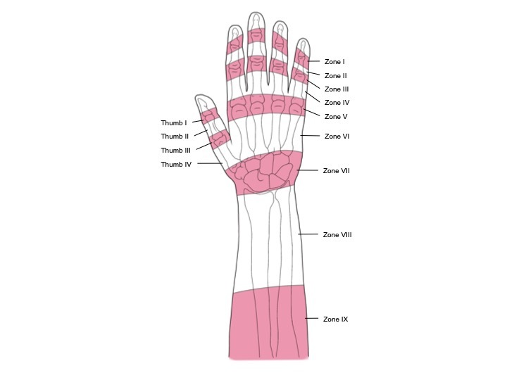 Hand Extensor Tendon Zones | The Best Porn Website