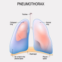 Pleural Effusion: Causes, Symptoms And Treatment | Netmeds