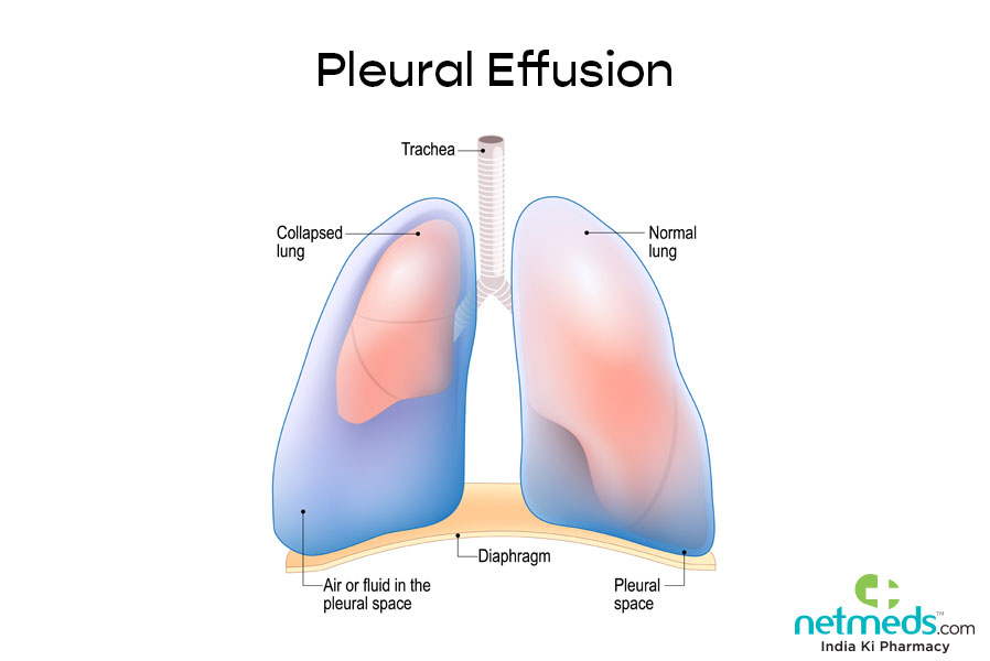 Pleural Effusion: Causes, Symptoms And Treatment | Netmeds