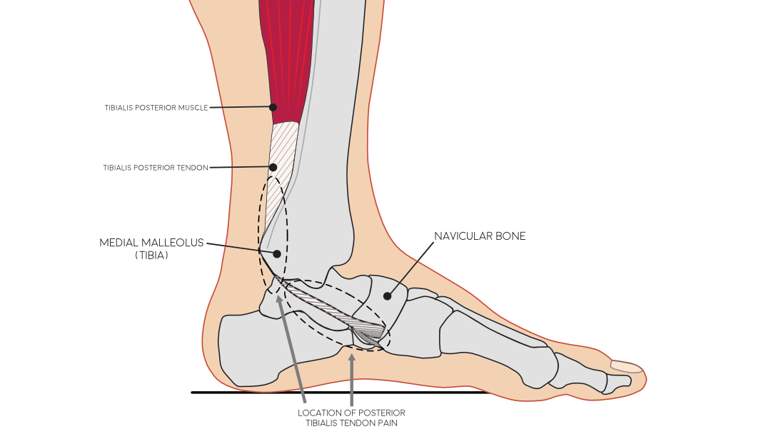 Tibialis Posterior