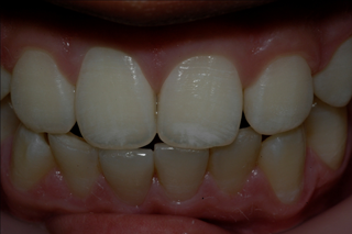 MildFluorosis.png