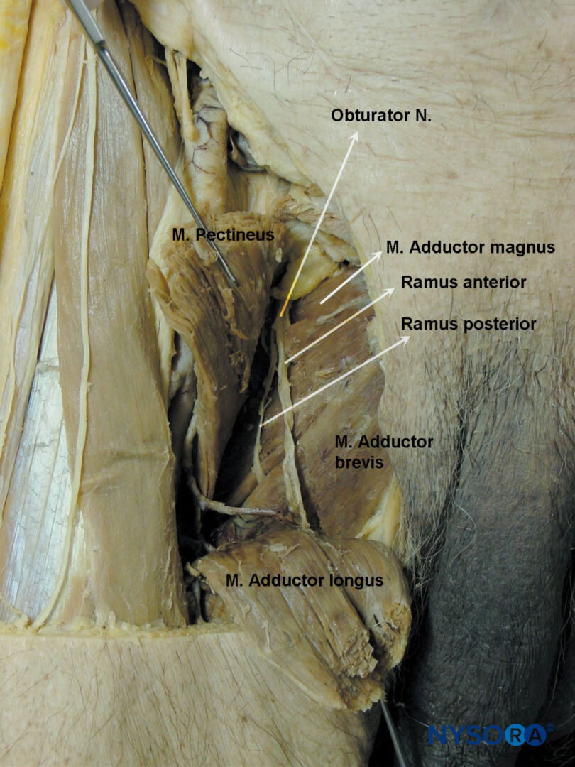 Obturator Nerve Cadaver