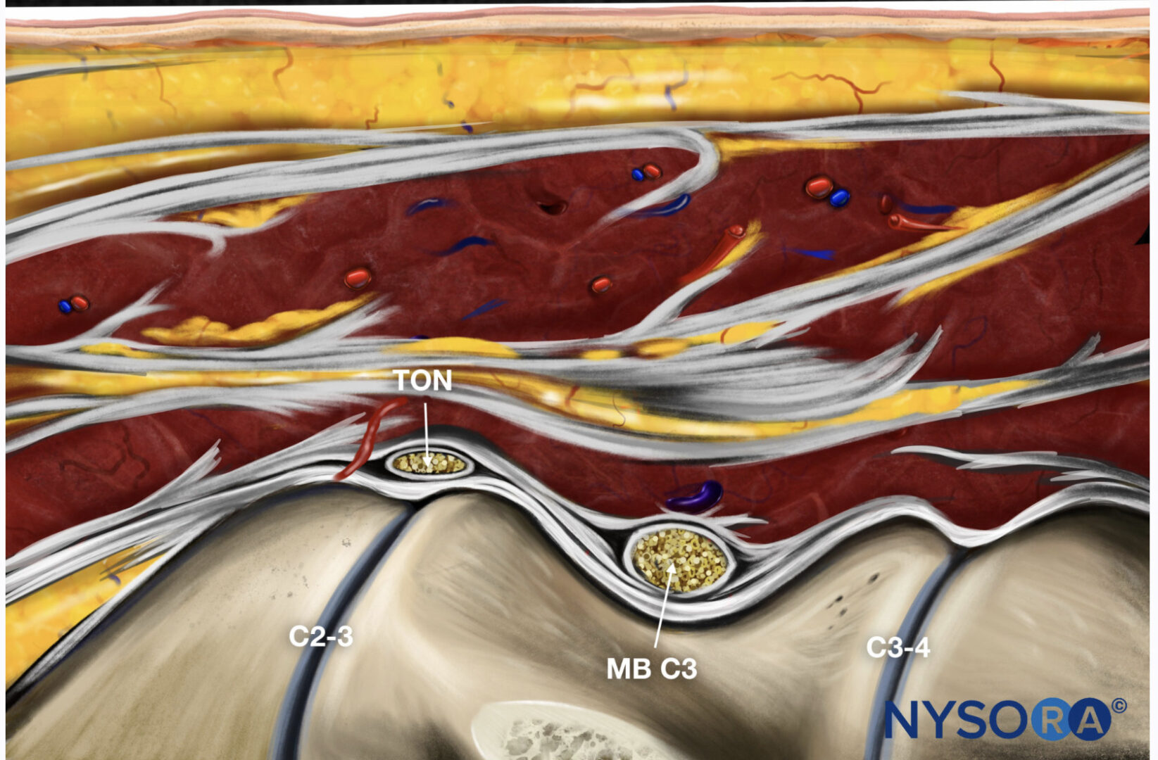 Third Occipital Nerve