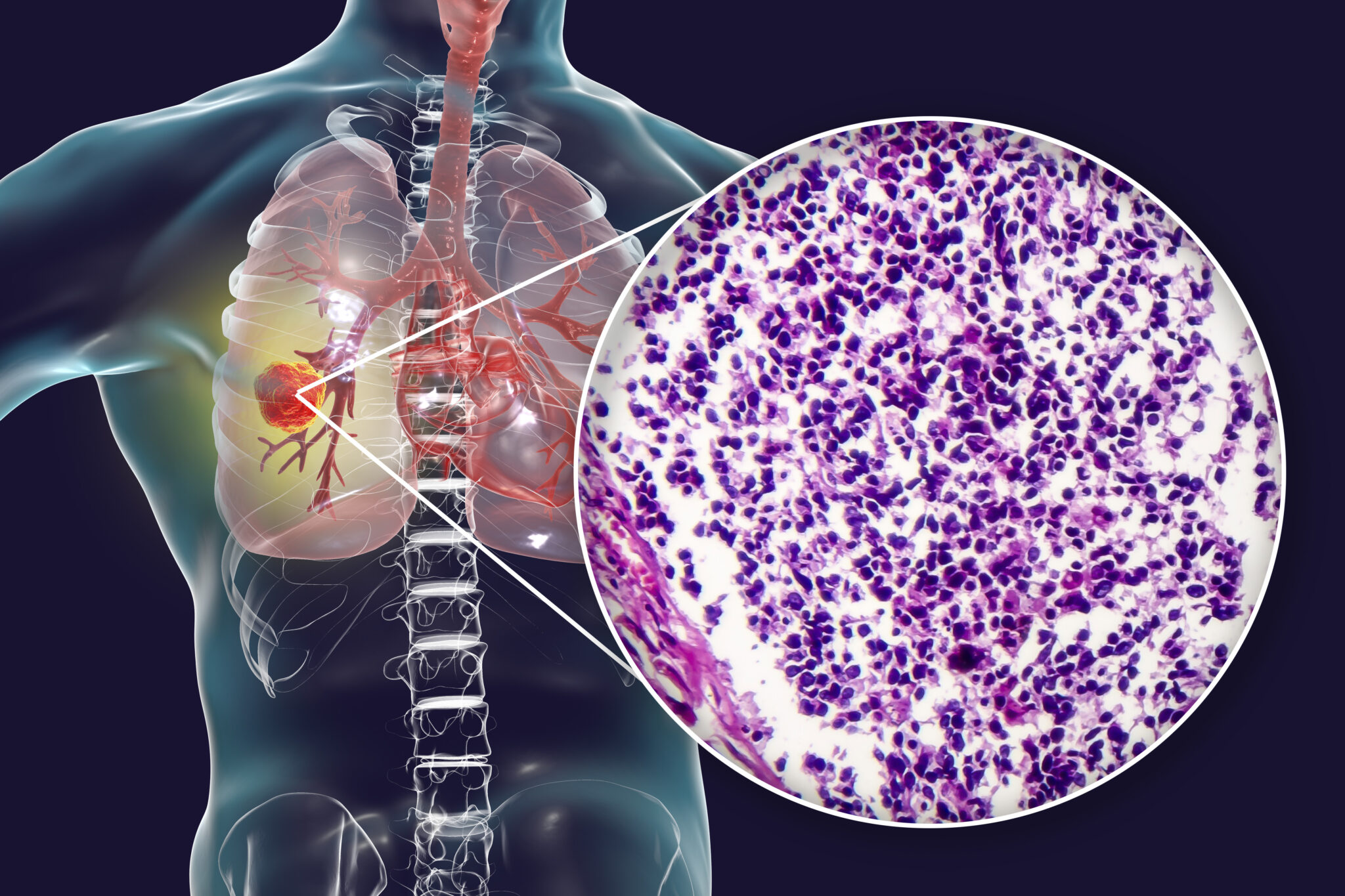 Novel Target Protein Discovered to Treat Small Cell Lung Cancer ...