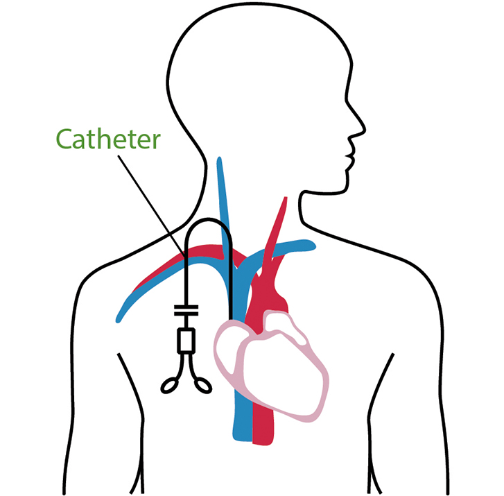 Central Venous Catheter Tip Position On Chest Radiogr - vrogue.co