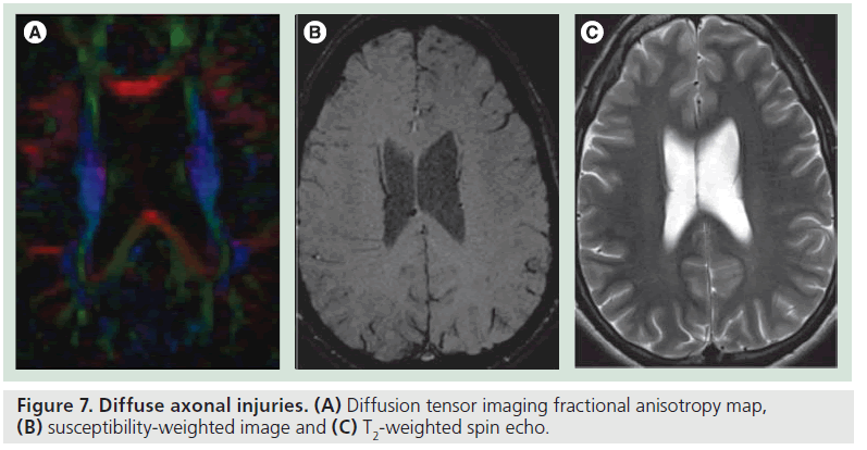 imaging-in-medicine-Diffusion-tensor