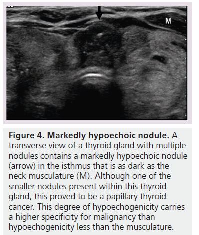 imaging-in-medicine-hypoechoic-nodule