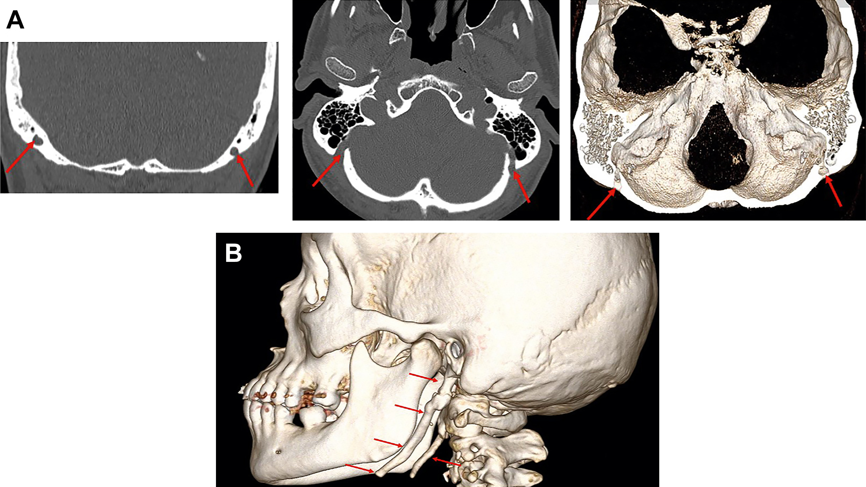 Anatomy and Pathology of the Skull Base - Oral and Maxillofacial ...