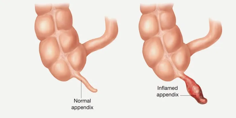 Appendicitis