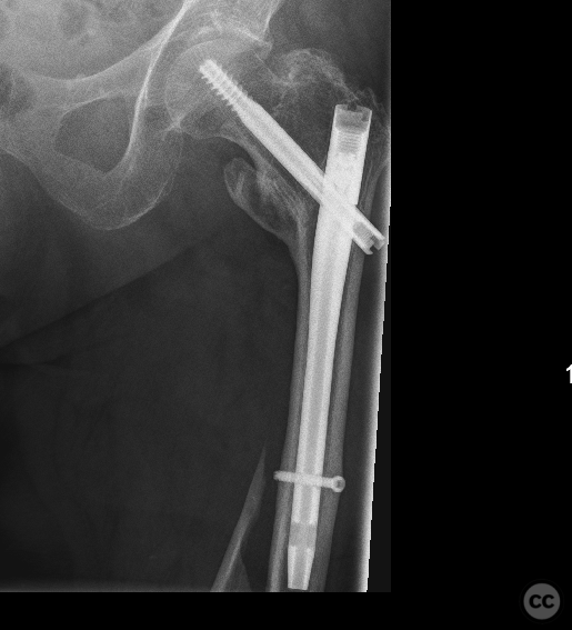 Periosteosynthetic distal femoral shaft fracture