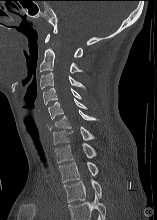 Anterior-only fusion of a teardrop C6/7 fracture