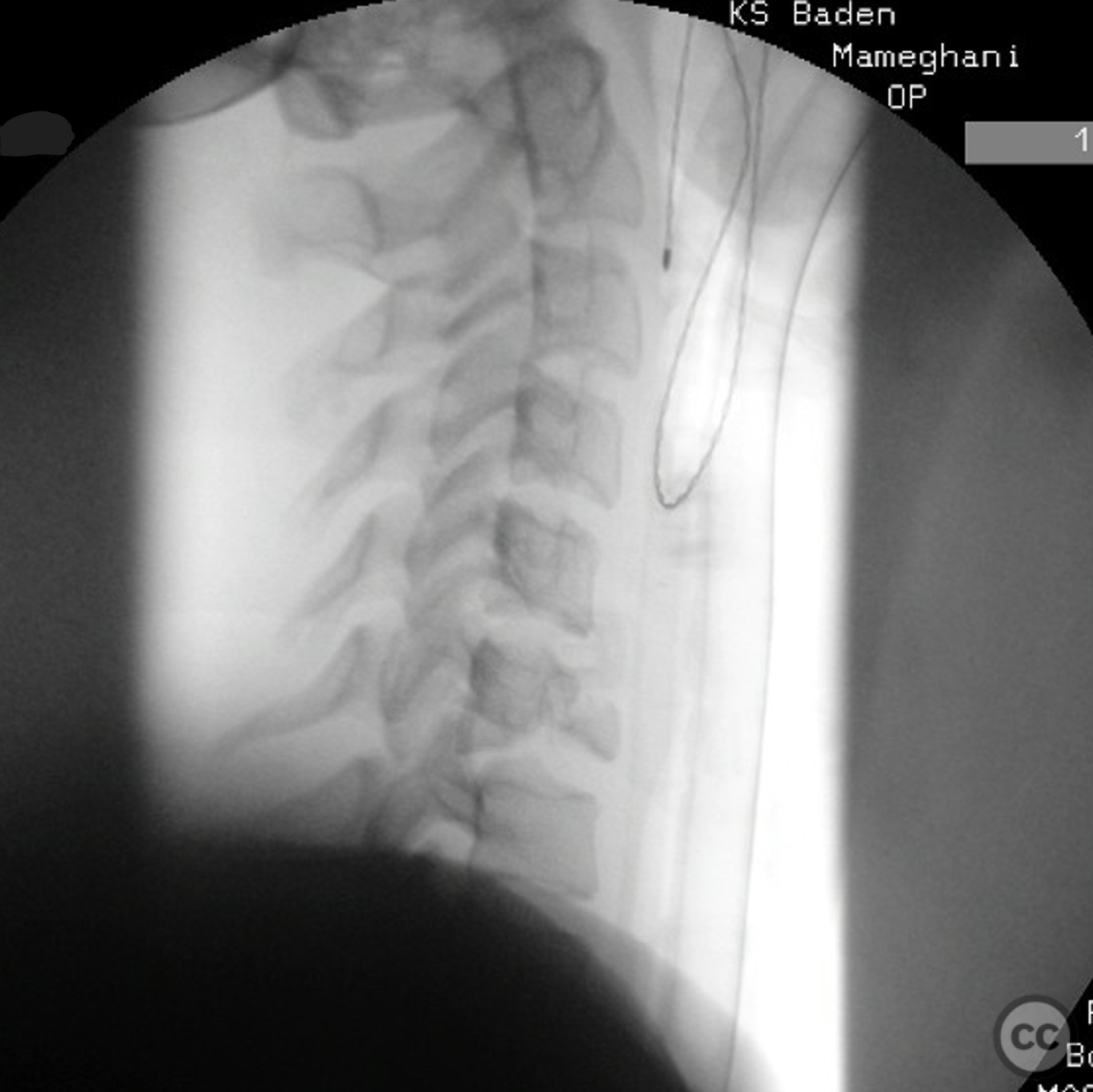 Anterior-only fusion of a teardrop C6/7 fracture