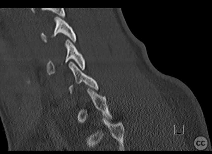 Anterior-only fusion of a teardrop C6/7 fracture