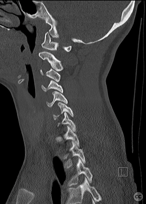 Anterior-only fusion of a teardrop C6/7 fracture