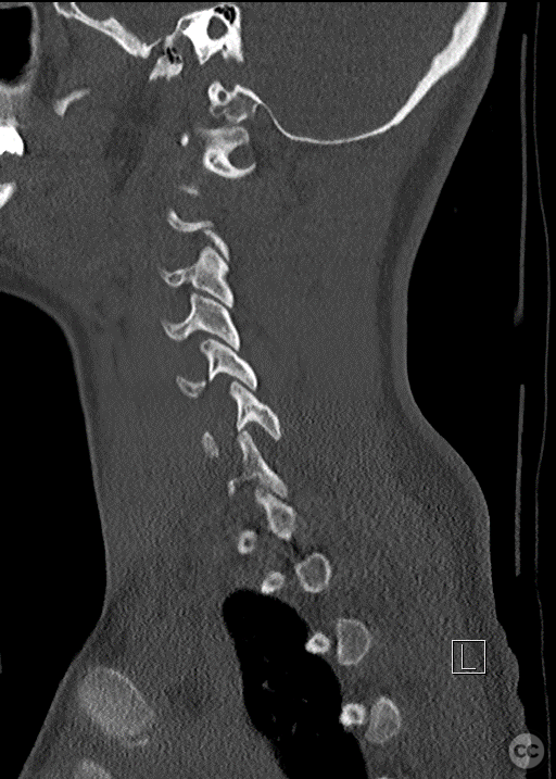 Anterior-only fusion of a teardrop C6/7 fracture