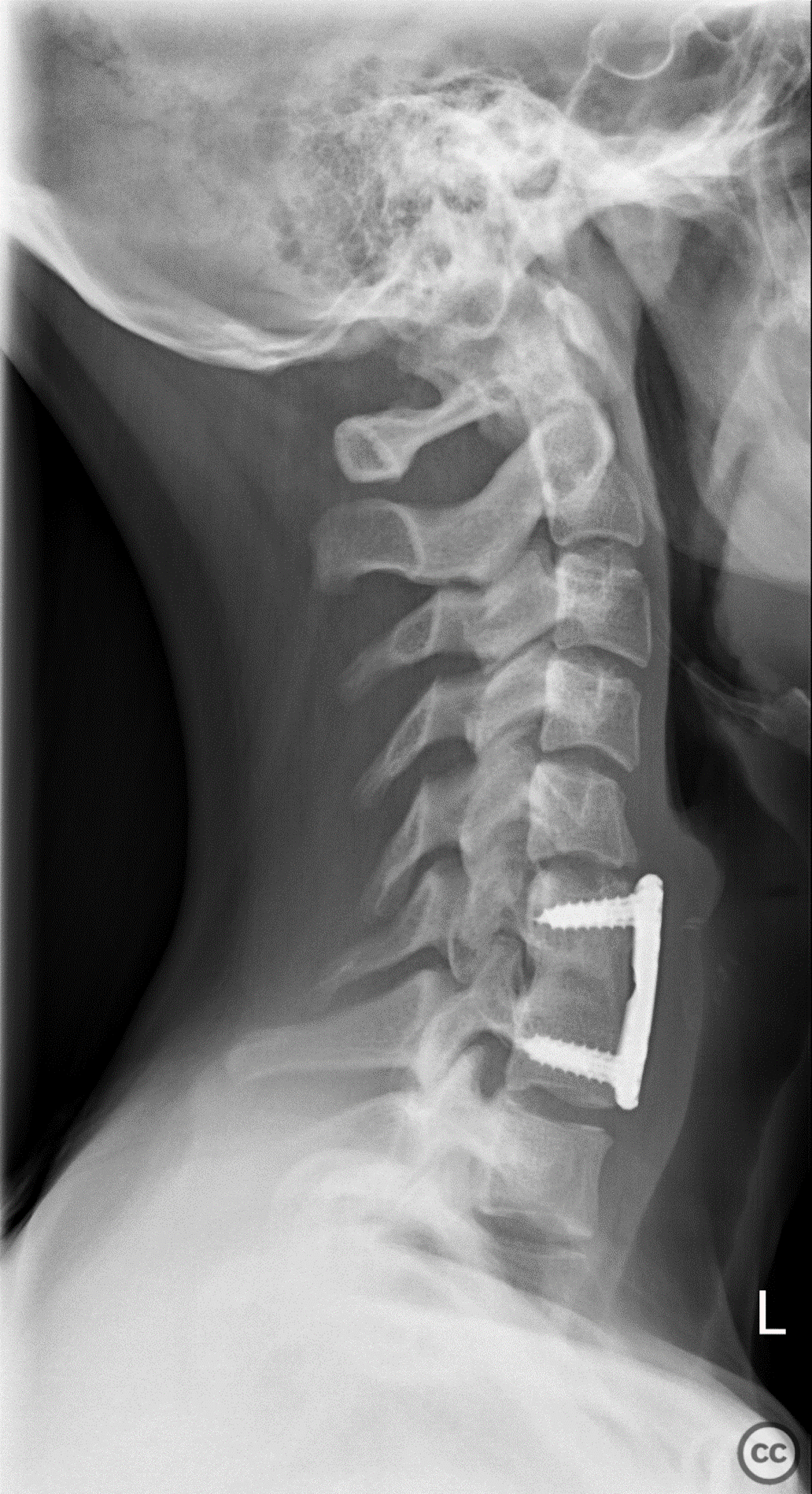 Anterior-only fusion of a teardrop C6/7 fracture