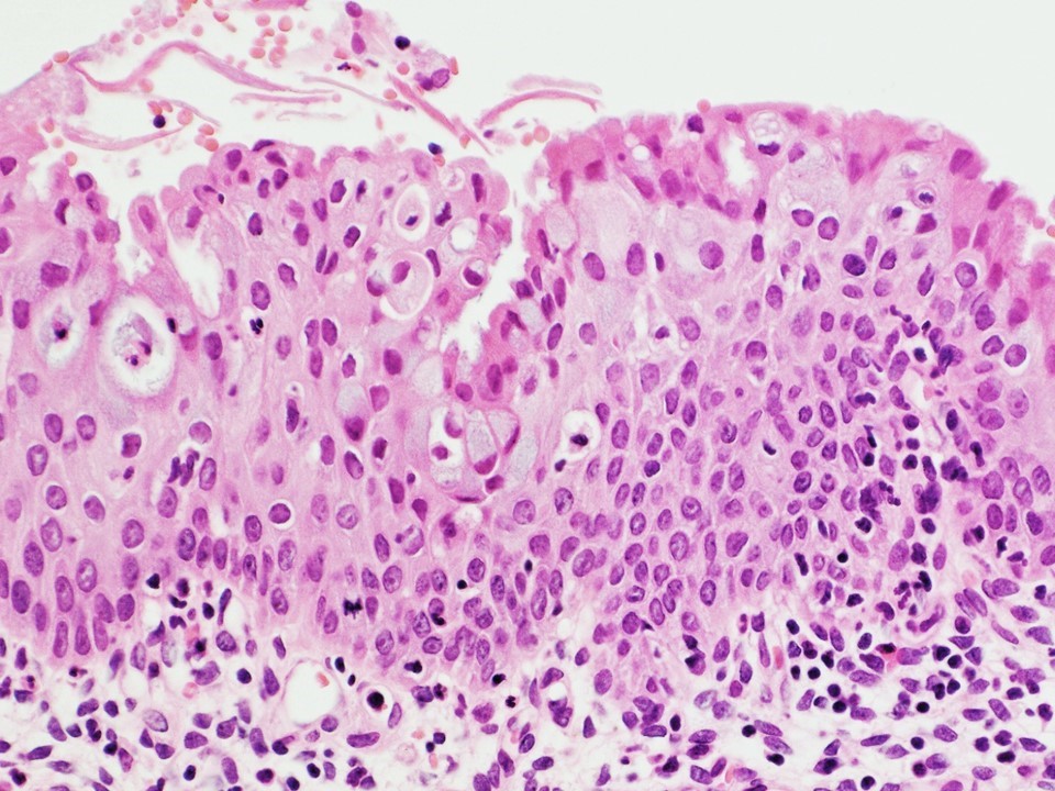 Pathology Outlines Squamous Metaplasia