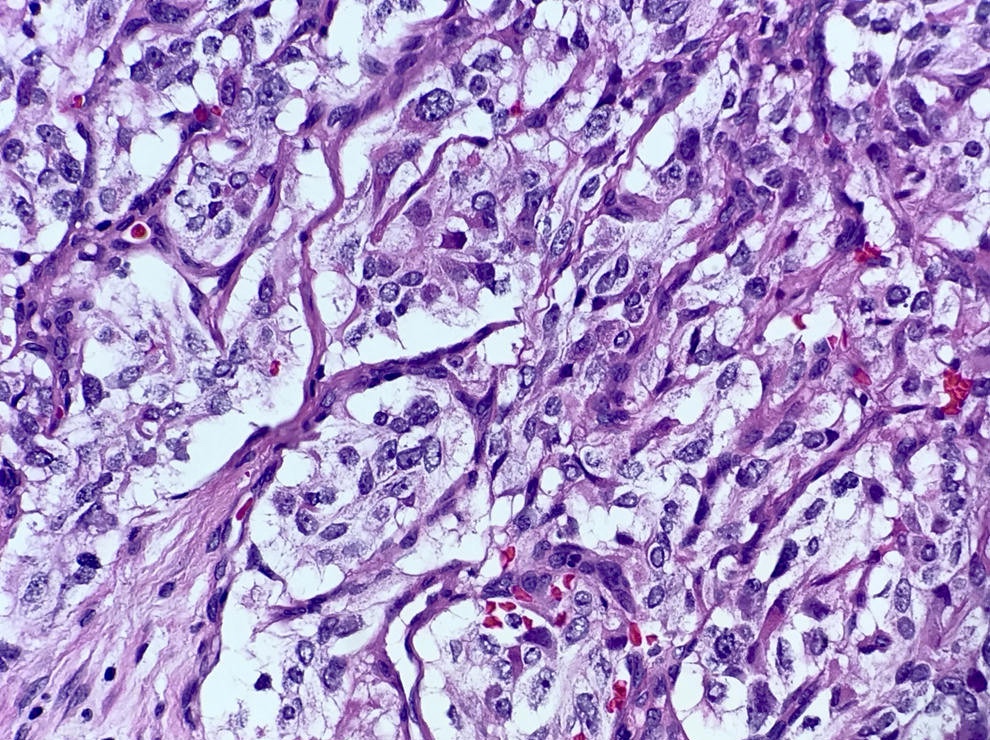 Pathology Outlines - Middle ear paraganglioma