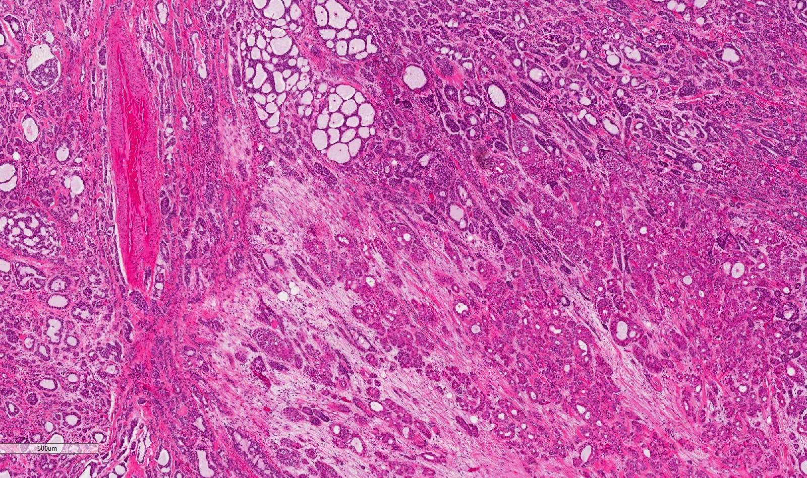 Pathology Outlines - Adenoid cystic carcinoma