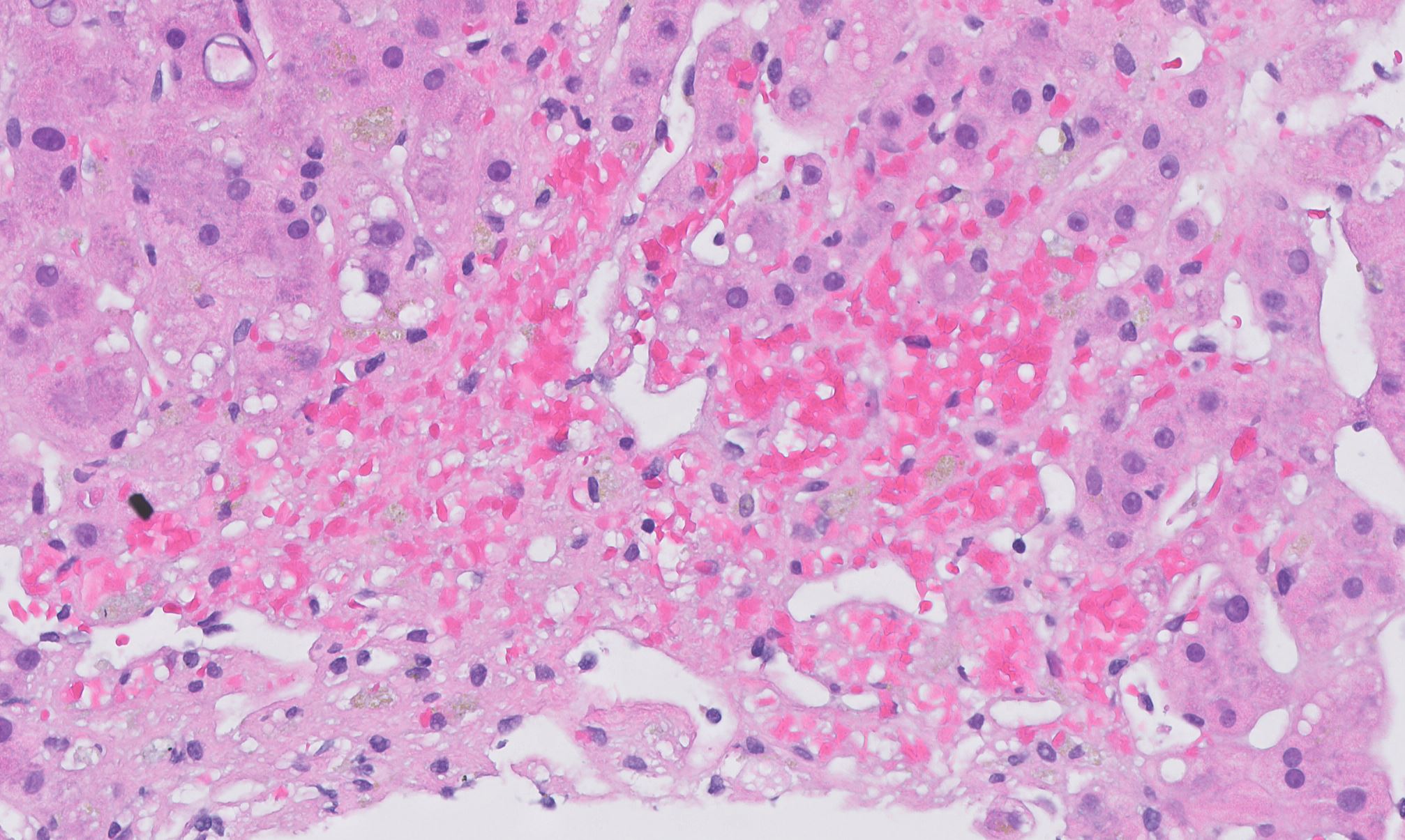 Chronic Venous Congestion Of The Spleen Histopathology