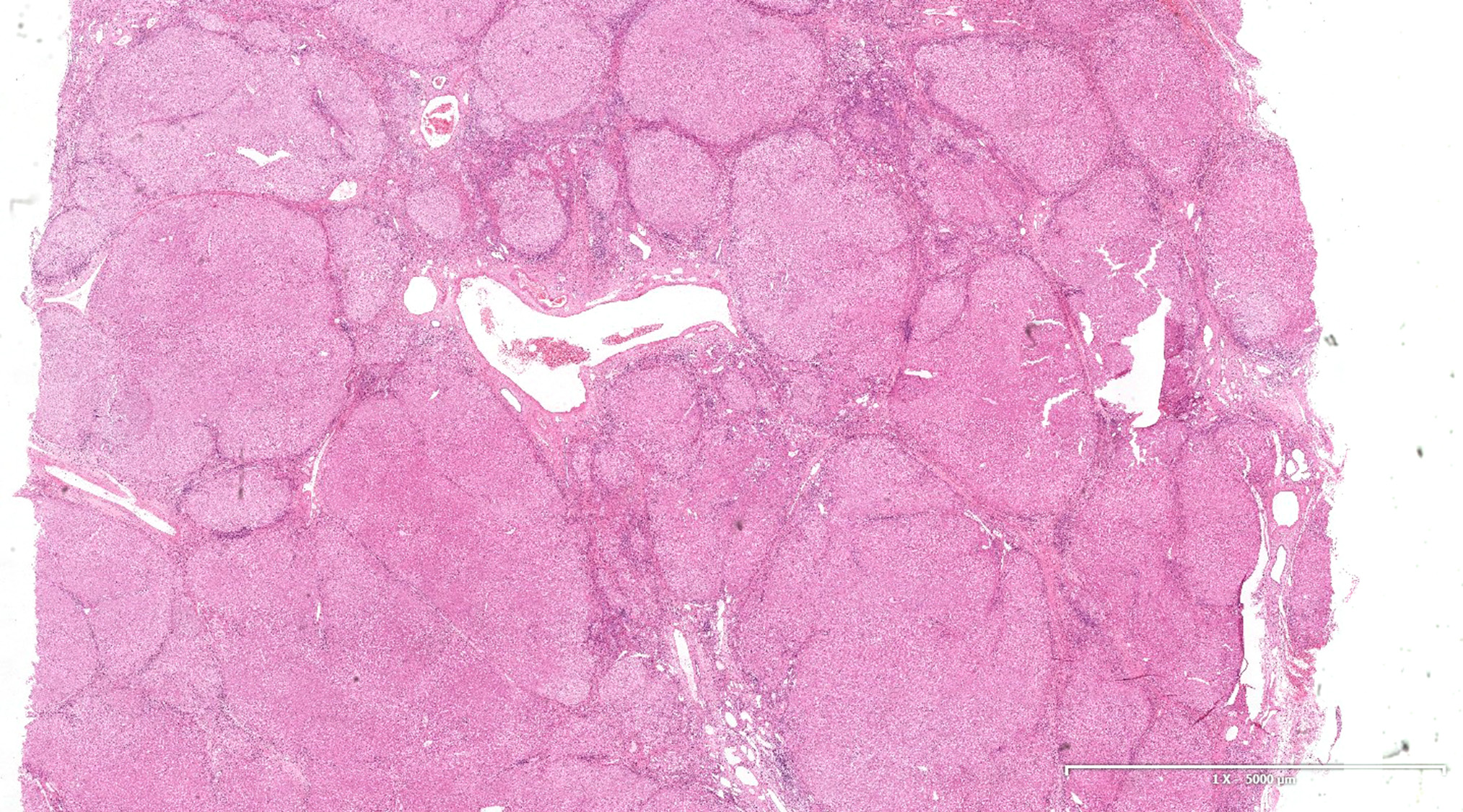 Liver Cirrhosis Pathology