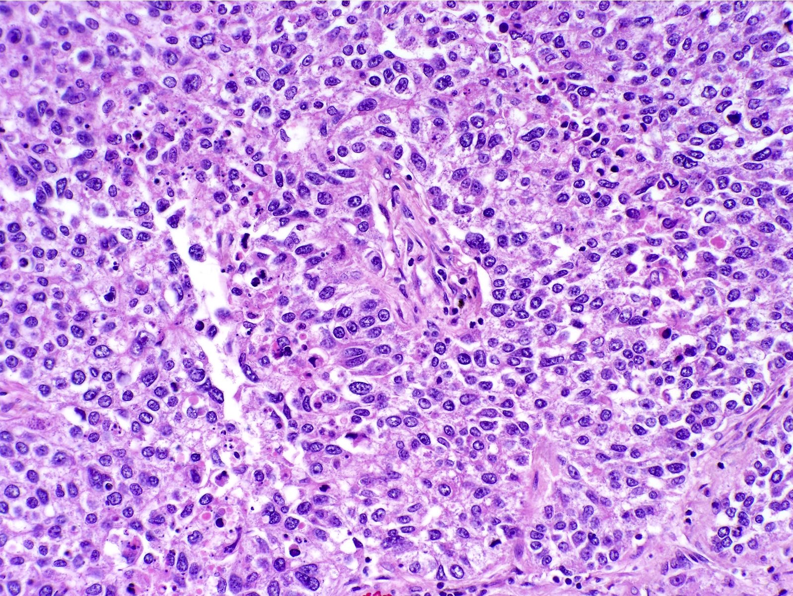 Small Cell Lung Cancer Histology